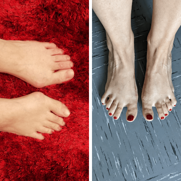 Die Füße vor und nach der Hallux-OP